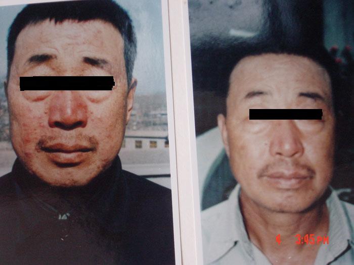 中州藥膏使用前后對比7