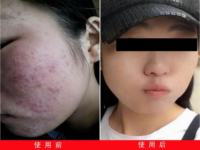 中州藥膏使用前后對比