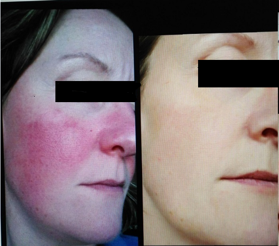 中州藥膏使用前后對比